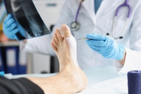 When to Consider Bunion Surgery