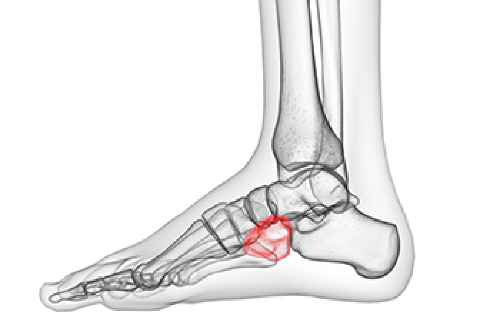 Outer Foot Pain May Indicate Cuboid Syndrome