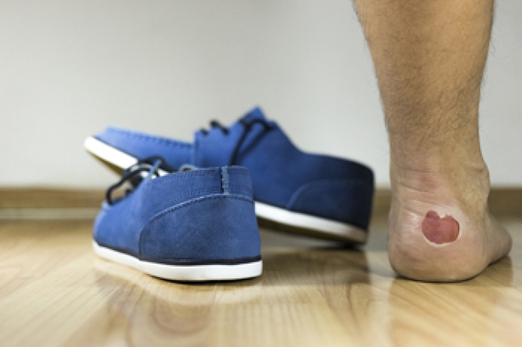 Foot Blisters Are Common in Runners