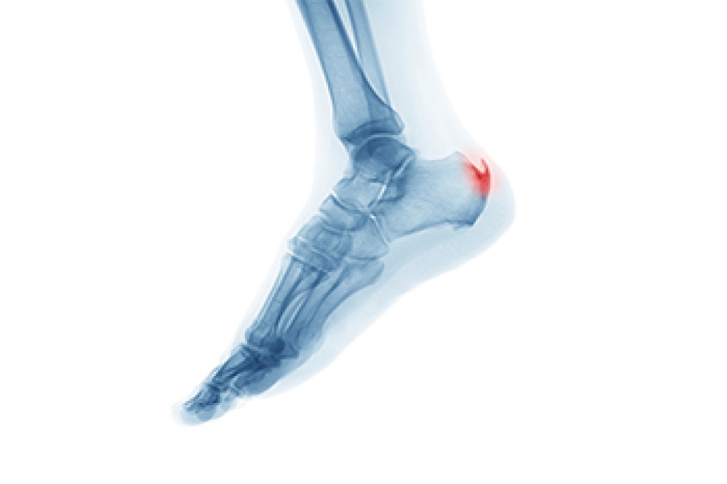 Location of Heel Spurs