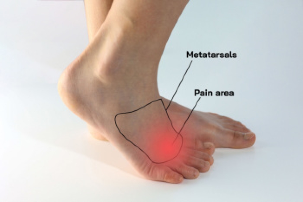 Causes and Symptoms of Morton’s Neuroma