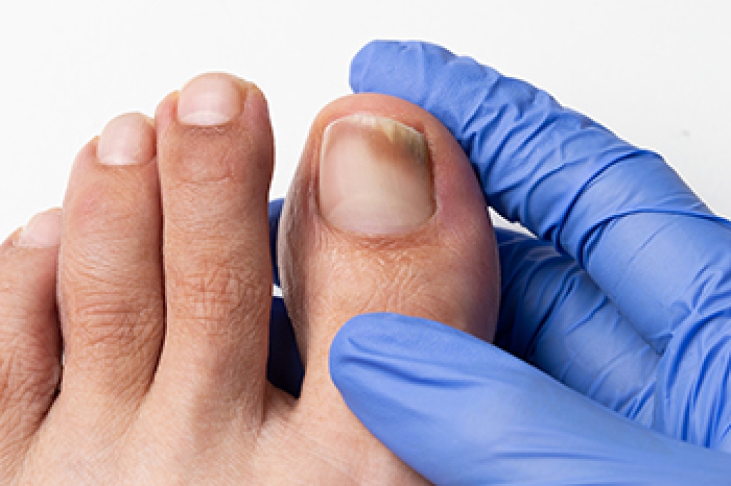 Toenail Fungus Warning Signs