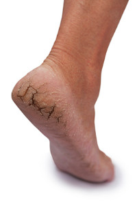 sore heel cracked skin