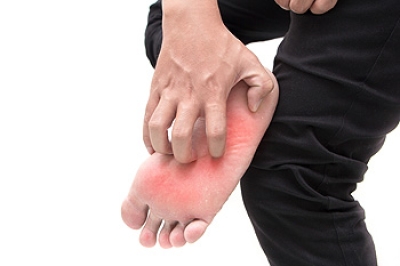 Common Symptoms of Athlete’s Foot