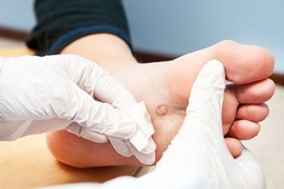 Transmission of Plantar Warts