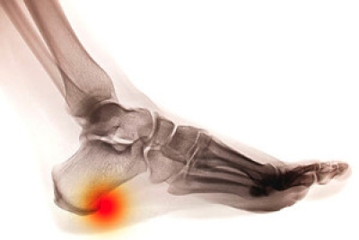 What is the Difference Between a Heel Spur and Plantar Fasciitis?