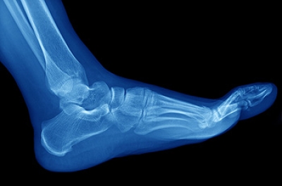 Where Is Pain from Cuboid Syndrome Located?