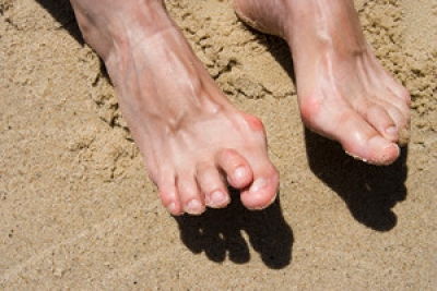 The Difficulties of Having a Hammertoe