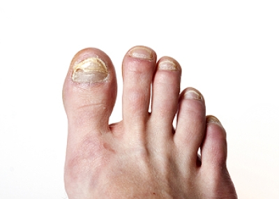 Thickened Toenails May Be Toenail Fungus