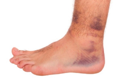 Different Types of Ankle Sprains