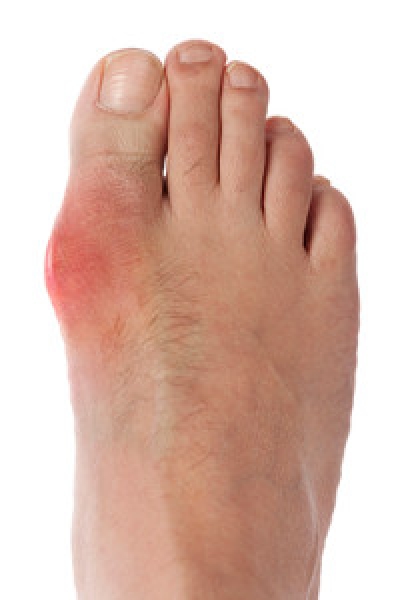 What is Gout?