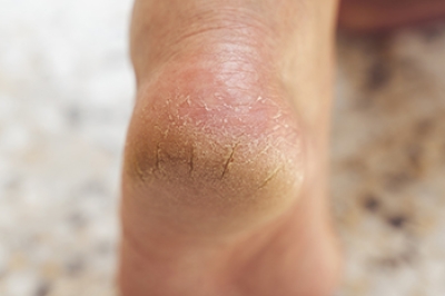 Why Are Cracked Heels More Common in Winter?