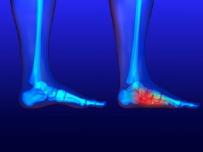 How to Tell If You Have Flat Feet