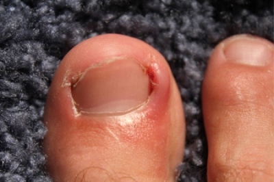 How Do Ingrown Toenails Develop?