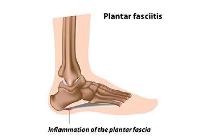 Risks of Plantar Fasciitis in Diabetic Patients
