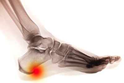 Possible Causes and Symptoms of  Heel Spurs