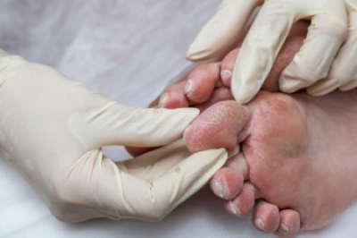Taking Care of Diabetic Feet