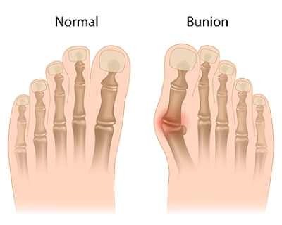 Managing Bunions