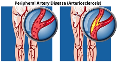 The Two Types of Peripheral Artery Disease