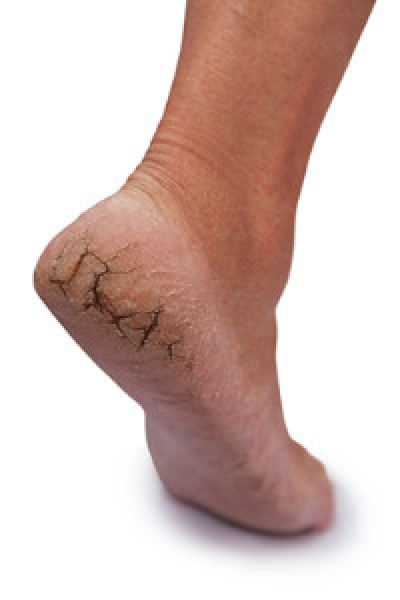 Possible Causes of Cracked Heels