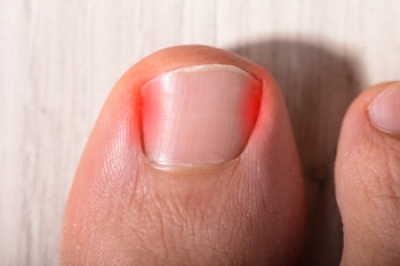 What Can Cause an Ingrown Toenail?