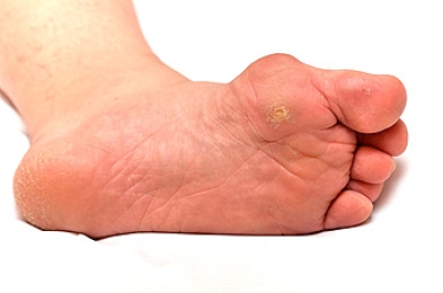 What Is a Bunion?