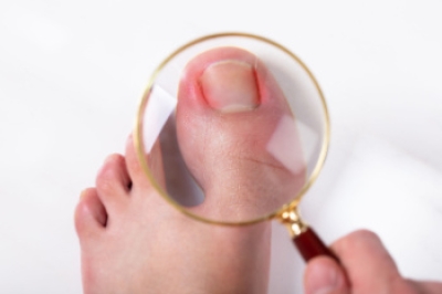 What Is an Ingrown Toenail?