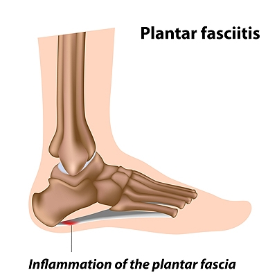 Seeing a Podiatrist for Plantar Fasciitis