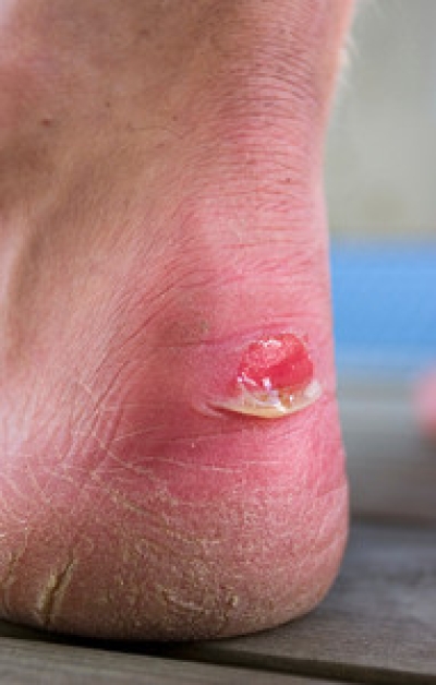 Blisters and Diabetic Foot Care