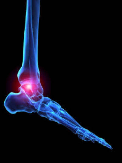 What is Arthritis?