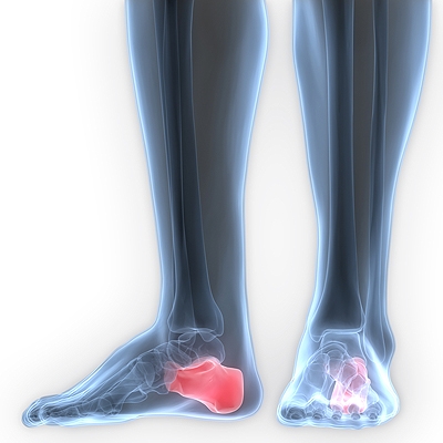 Causes of Heel Spurs